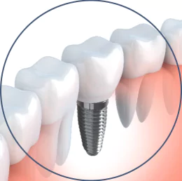 dental-implant-consultation-offer